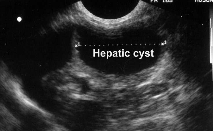 Ultrasound Liver Images